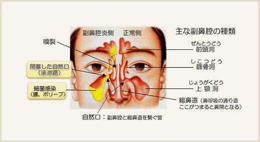 副鼻腔炎、蓄膿って治りますか?