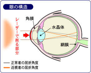 レーシックその後【手術経験者】
