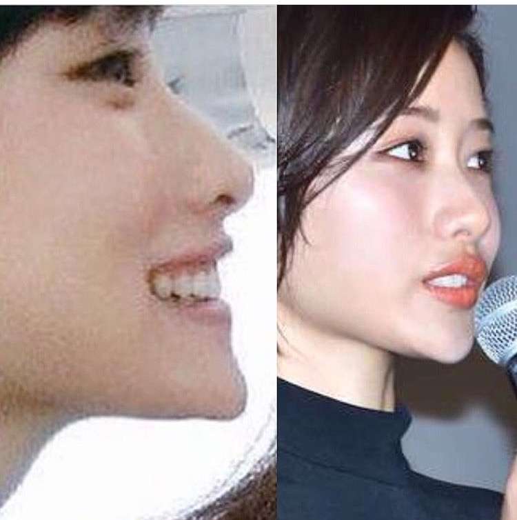 鼻にプロテーゼの線がくっきり 演技が頭に入らないくらい鼻の形が気になる美人芸能人たち ガールズちゃんねる Girls Channel