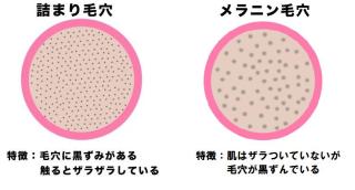毛穴の黒ずみのケアの仕方