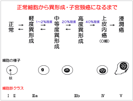 高度異形成と診断された人