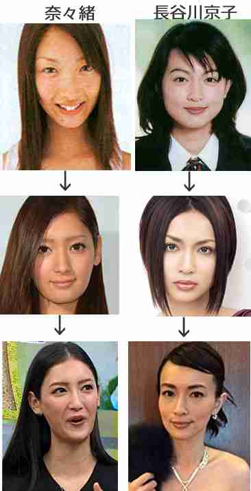 芸能人の整形アンケート調査【プラマイ】