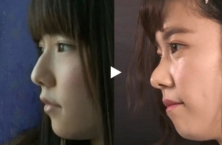 芸能人の整形アンケート調査【プラマイ】