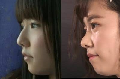 芸能人の整形アンケート調査【プラマイ】