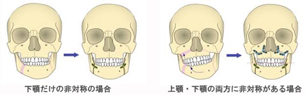 顔の歪みが気になる