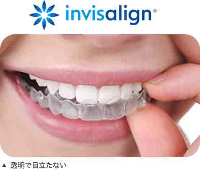 インビザライン矯正をしている、していた方