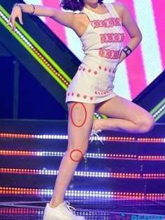 脂肪溶解注射したことある人 ガールズちゃんねる Girls Channel