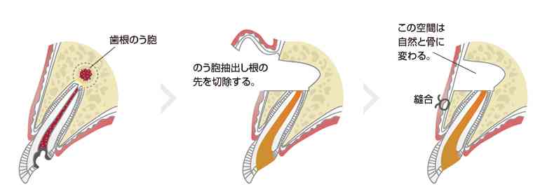 根管治療について語ろう