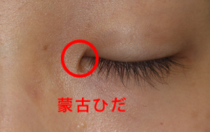 蒙古襞(もうこひだ)の利点
