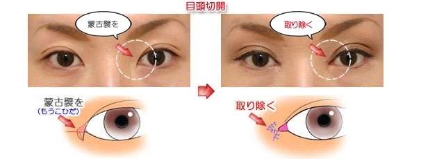 蒙古襞(もうこひだ)の利点