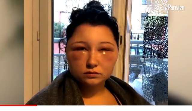 【閲覧注意】市販のヘアカラー剤を使った女性、頭が「電球」のように腫れ上がる