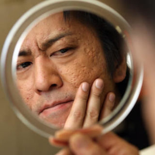 過去に肌が汚かったけど綺麗になった方 ガールズちゃんねる Girls Channel