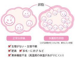 多嚢胞性卵巣症候群で出産できた方