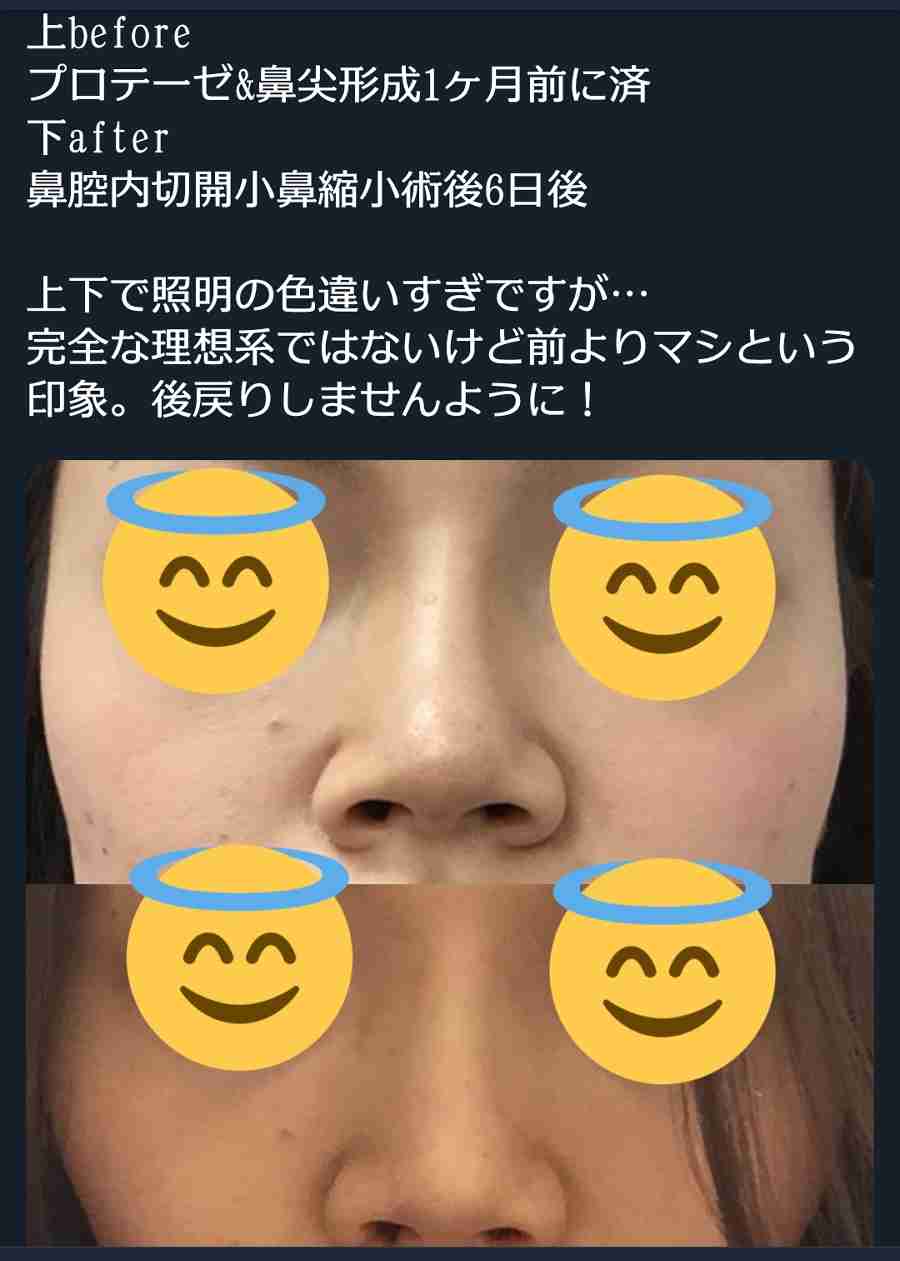 現役高校生の60%が「整形」に興味 したいのは「目」よりも「鼻」