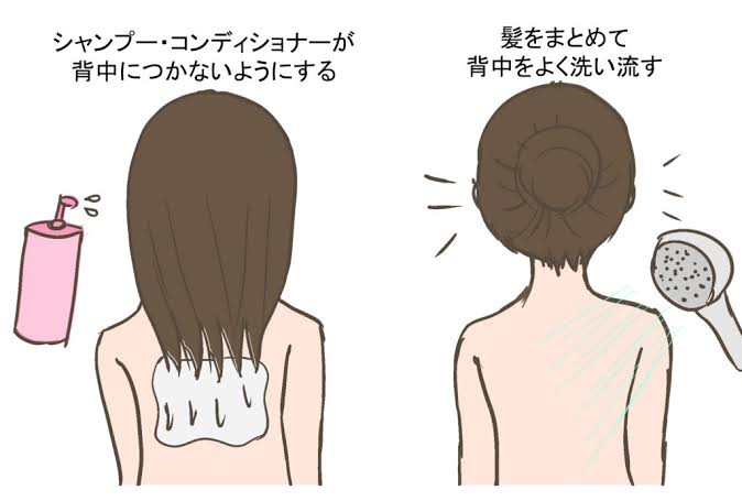 背中のニキビについて