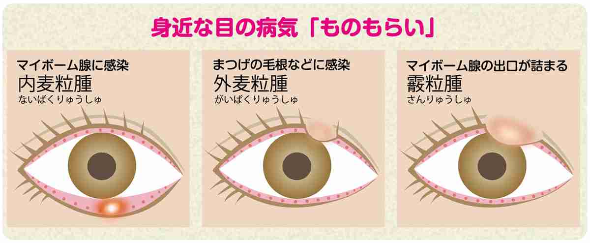 外まぶたものもらいの症状は何ですか?