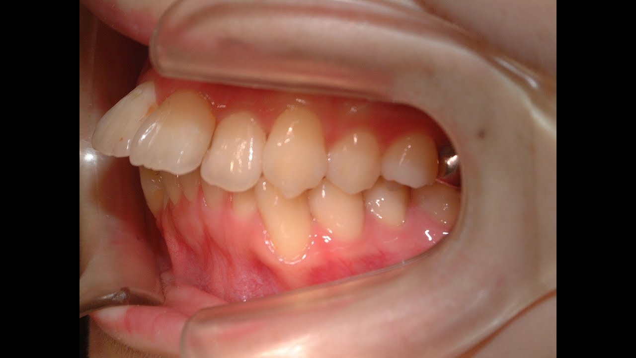 【心】歯並びが悪すぎて疲れる【体調】