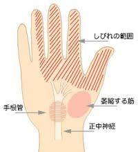 手 根 管 症候群 これ で シビレ 痛み が 消え た