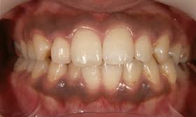 歯茎をピンクにしたい