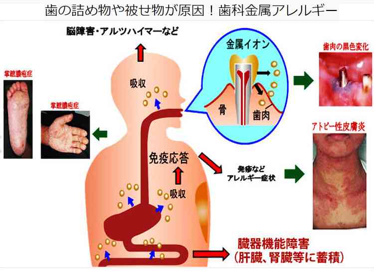 30代の方、銀歯いくつ入れていますか?