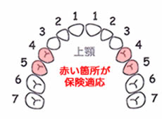30代の方、銀歯いくつ入れていますか?