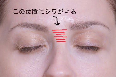 眉間のシワ対策、何してますか？