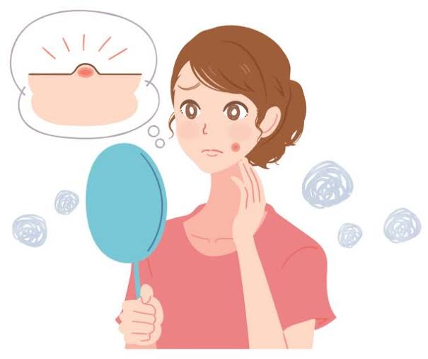 顎ニキビをどうにかしたい!