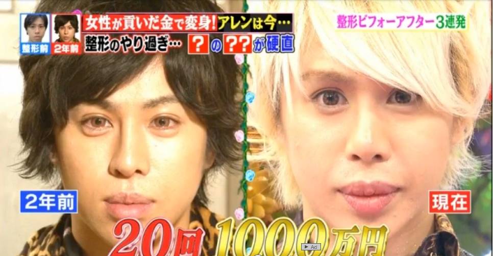 整形に9000万円！ 整形男子アレン、顔の激変と決意のワケを明かす