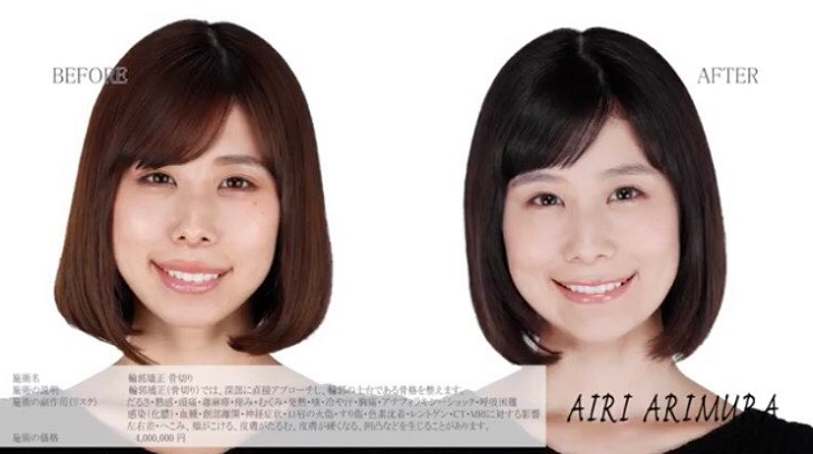 整形に9000万円！ 整形男子アレン、顔の激変と決意のワケを明かす