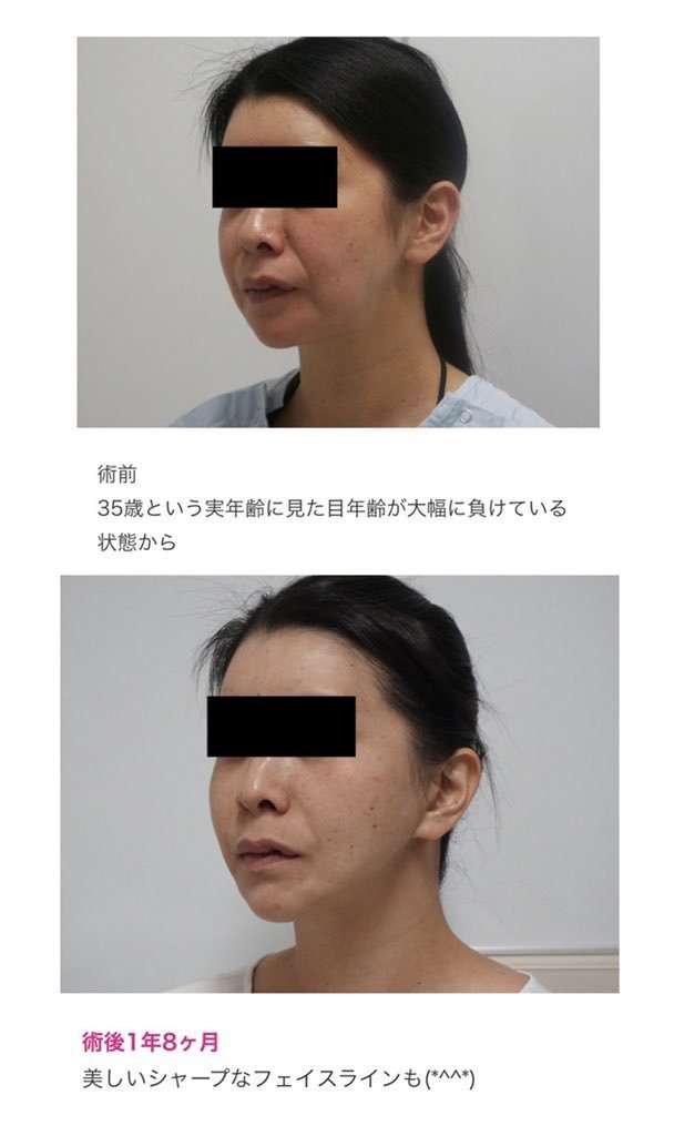 小顔整形したことある方！