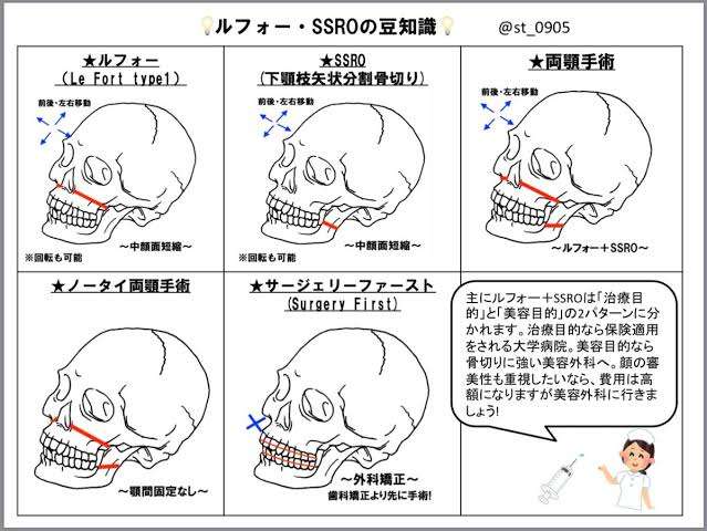 小顔整形したことある方！
