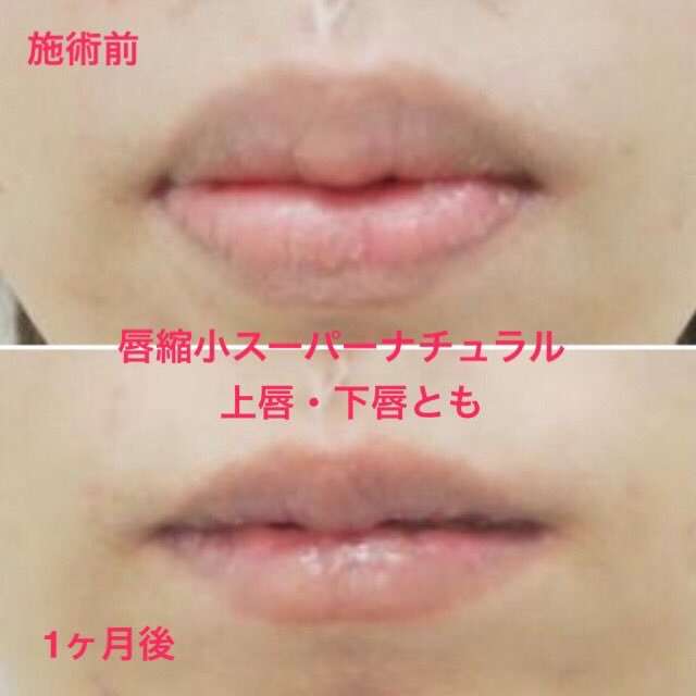 石原さとみ 整形失敗 鼻の下に違和感 新垣結衣や戸田恵梨香と同じ手術か ガールズちゃんねる Girls Channel