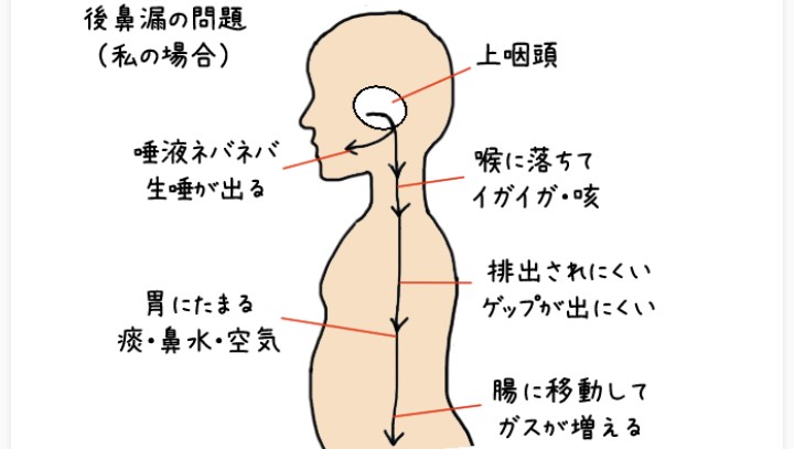 上咽頭炎から後鼻漏