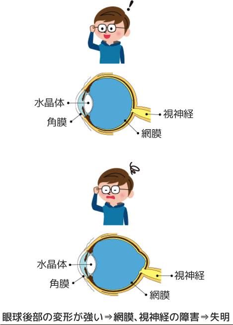 近視って母親から遺伝しますか？
