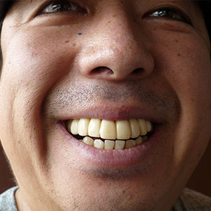 歯の被せ物をしている人！