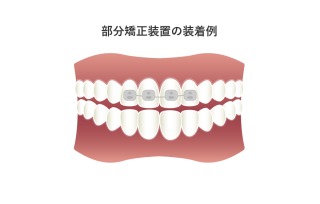 部分矯正したことある人いますか？