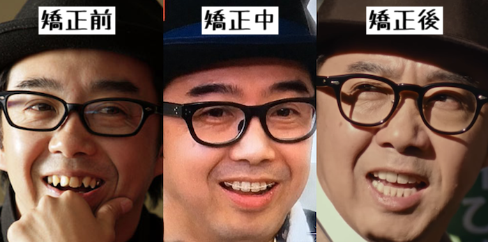 歯列矯正のビフォーアフターが見たい