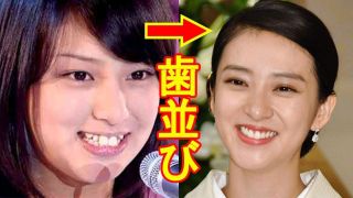 歯列矯正のビフォーアフターが見たい ガールズちゃんねる Girls Channel