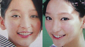歯列矯正のビフォーアフターが見たい