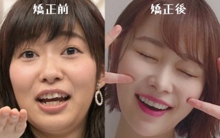 歯列矯正のビフォーアフターが見たい ガールズちゃんねる Girls Channel