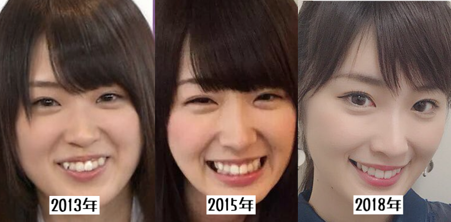 歯列矯正のビフォーアフターが見たい ガールズちゃんねる Girls Channel