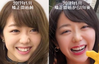 歯列矯正のビフォーアフターが見たい