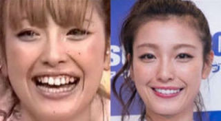 歯列矯正のビフォーアフターが見たい