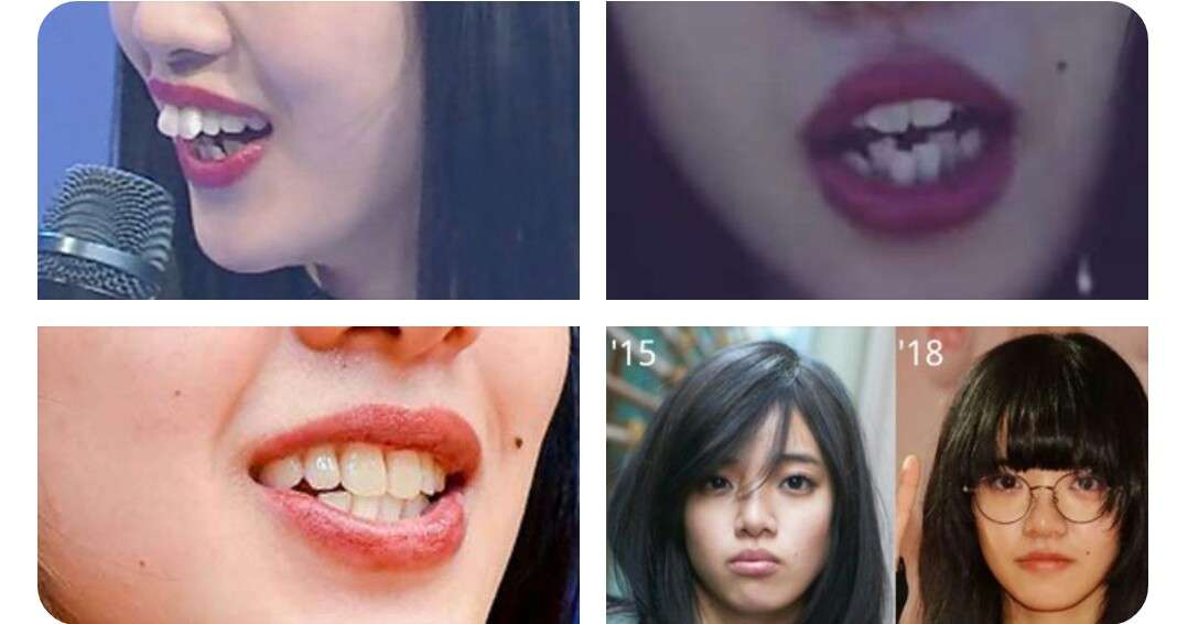 歯列矯正のビフォーアフターが見たい ガールズちゃんねる Girls Channel