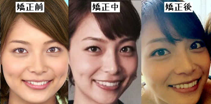 歯列矯正のビフォーアフターが見たい ガールズちゃんねる Girls Channel