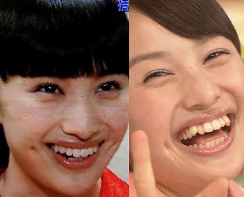 歯列矯正のビフォーアフターが見たい ガールズちゃんねる Girls Channel