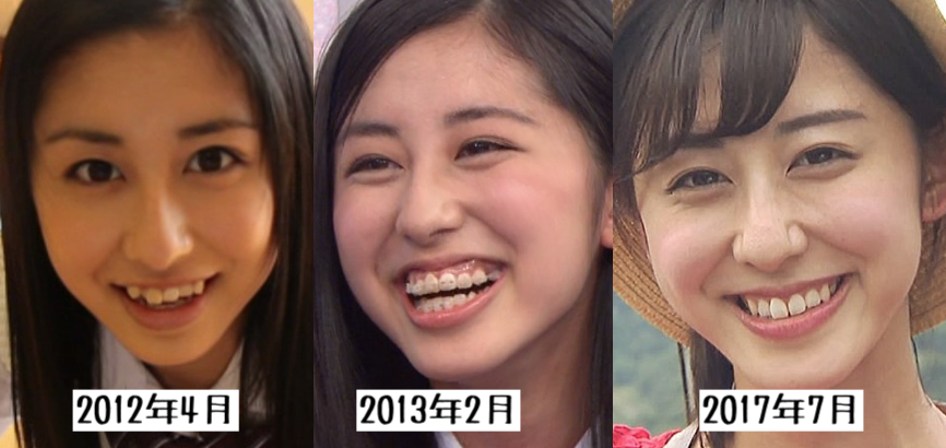 歯列矯正のビフォーアフターが見たい