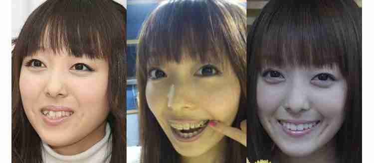 歯列矯正のビフォーアフターが見たい ガールズちゃんねる Girls Channel