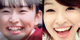 歯列矯正のビフォーアフターが見たい ガールズちゃんねる Girls Channel