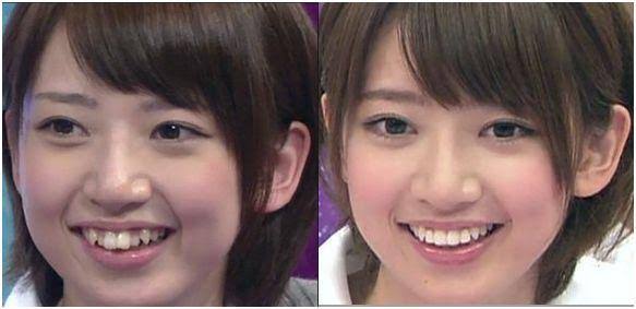 歯列矯正のビフォーアフターが見たい ガールズちゃんねる Girls Channel